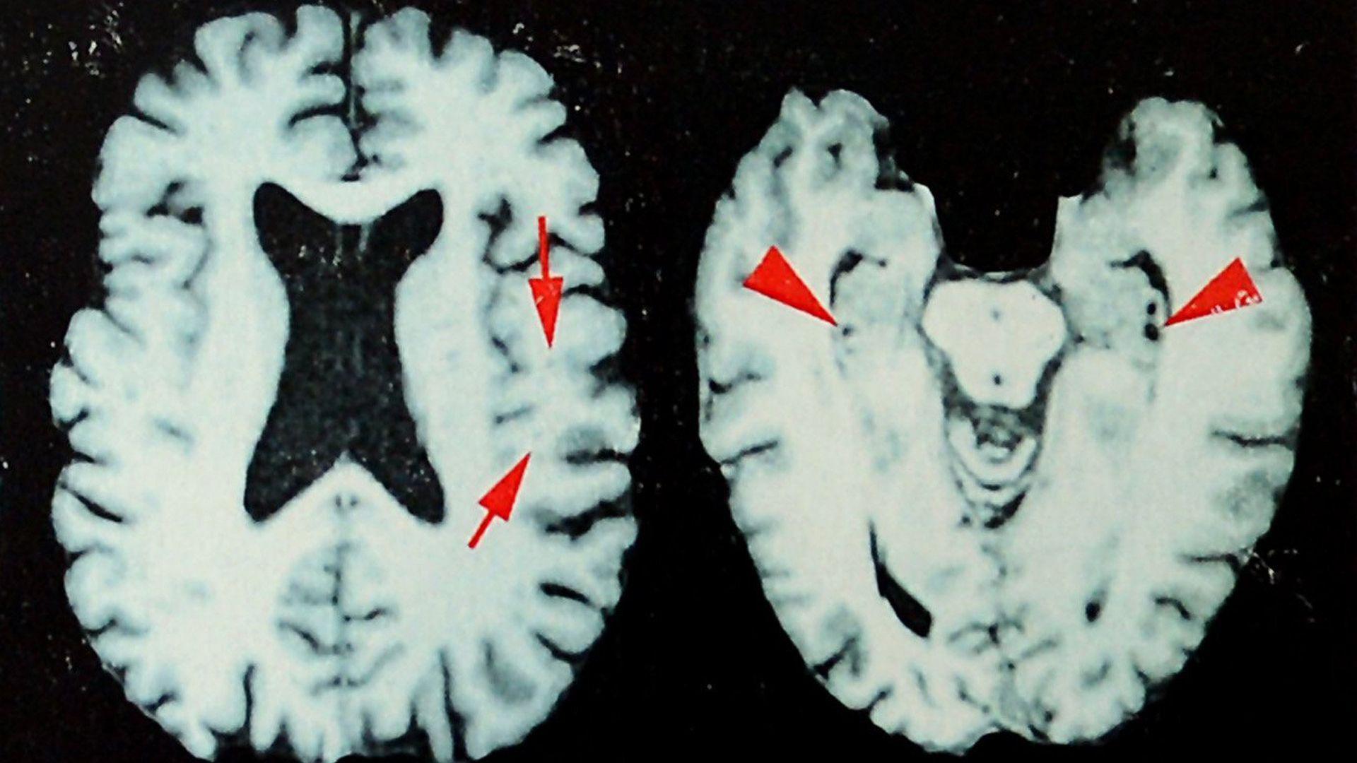 Dead NFL Players Found to Have Up to 97.7% CTE Prevalence
